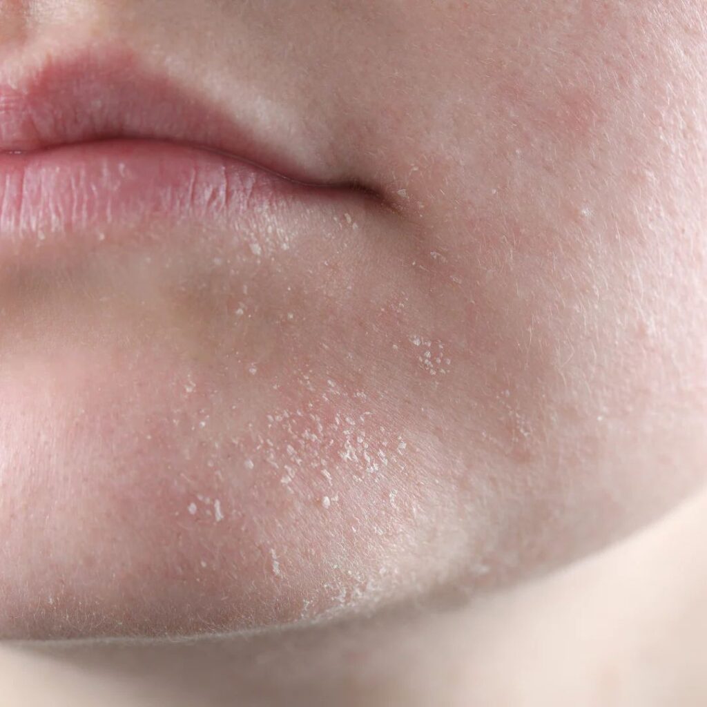 Understanding Transepidermal Water Loss (TEWL)