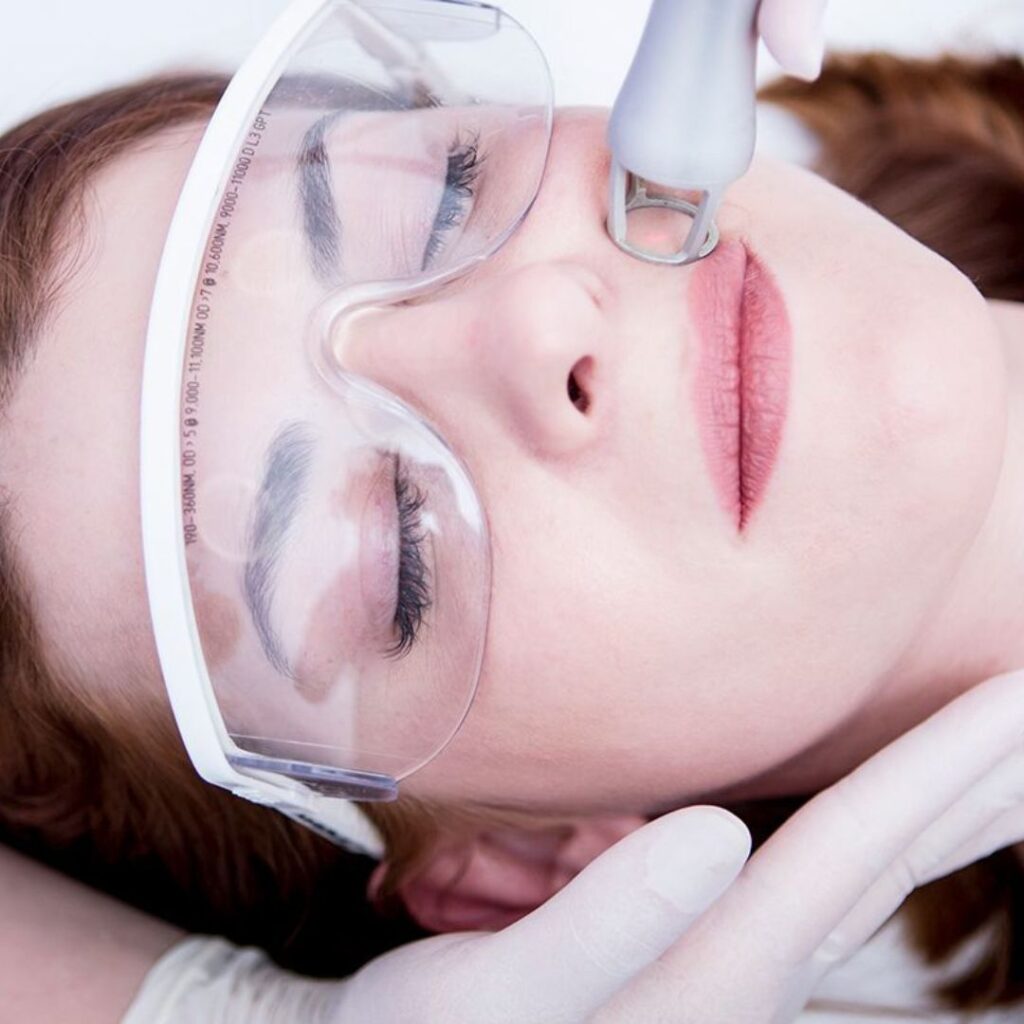 Micro-Needling vs Laser Resurfacing: Which Works Better?