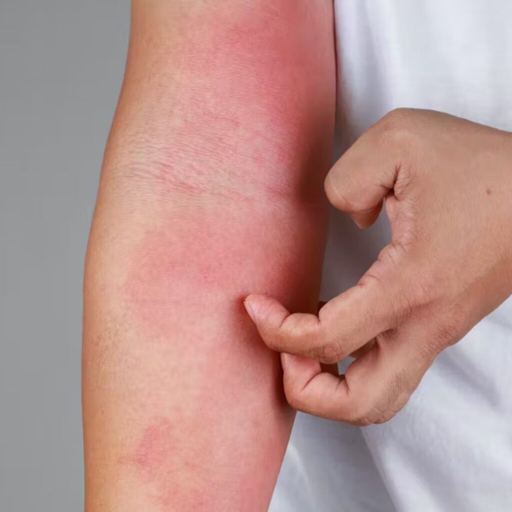 Winter Itching (Winter Pruritus): Causes & Effective Solutions