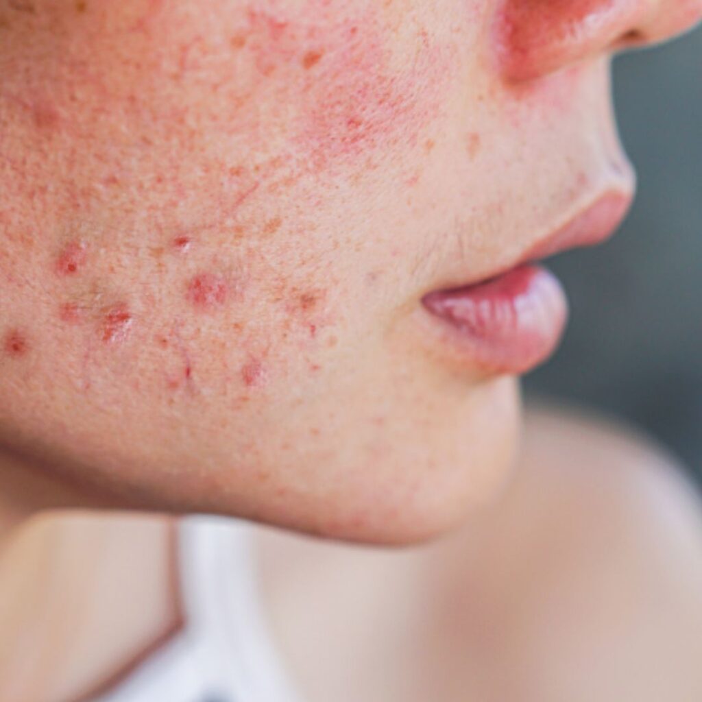 Winter Acne: Why Breakouts Increase in Cold Weather
