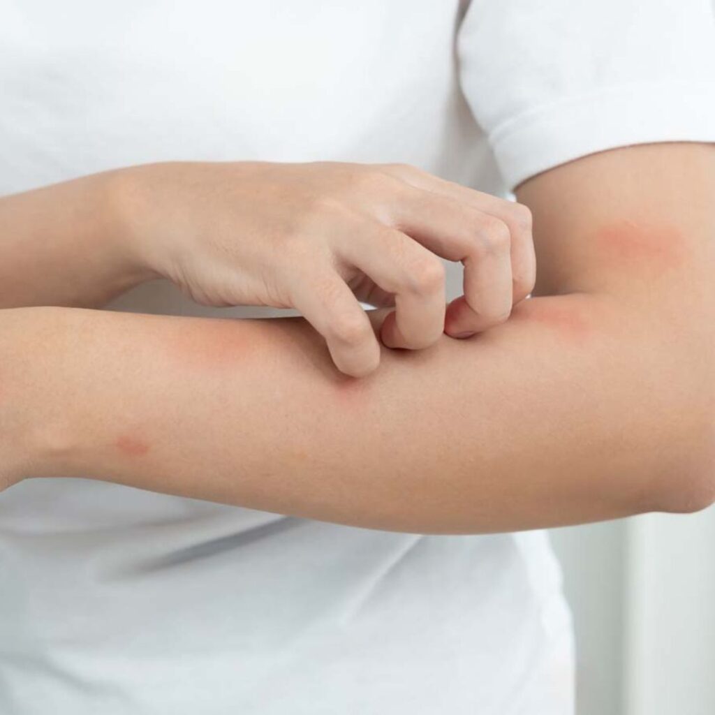 Winter Dermatitis: Common Causes and How Dermatologists Can Help