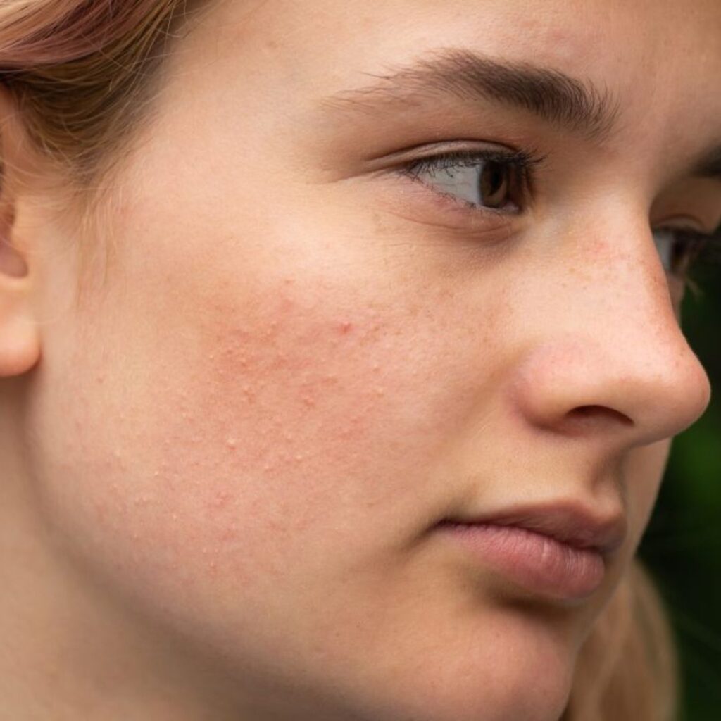 How to Prevent Sagging Skin During the Winter Season