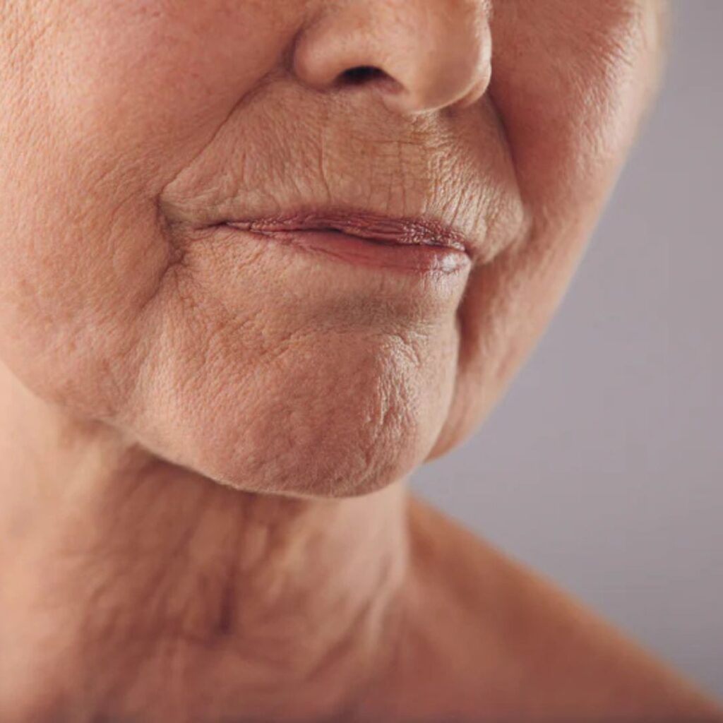 Winter Dryness & Its Role in Early Wrinkle Formation