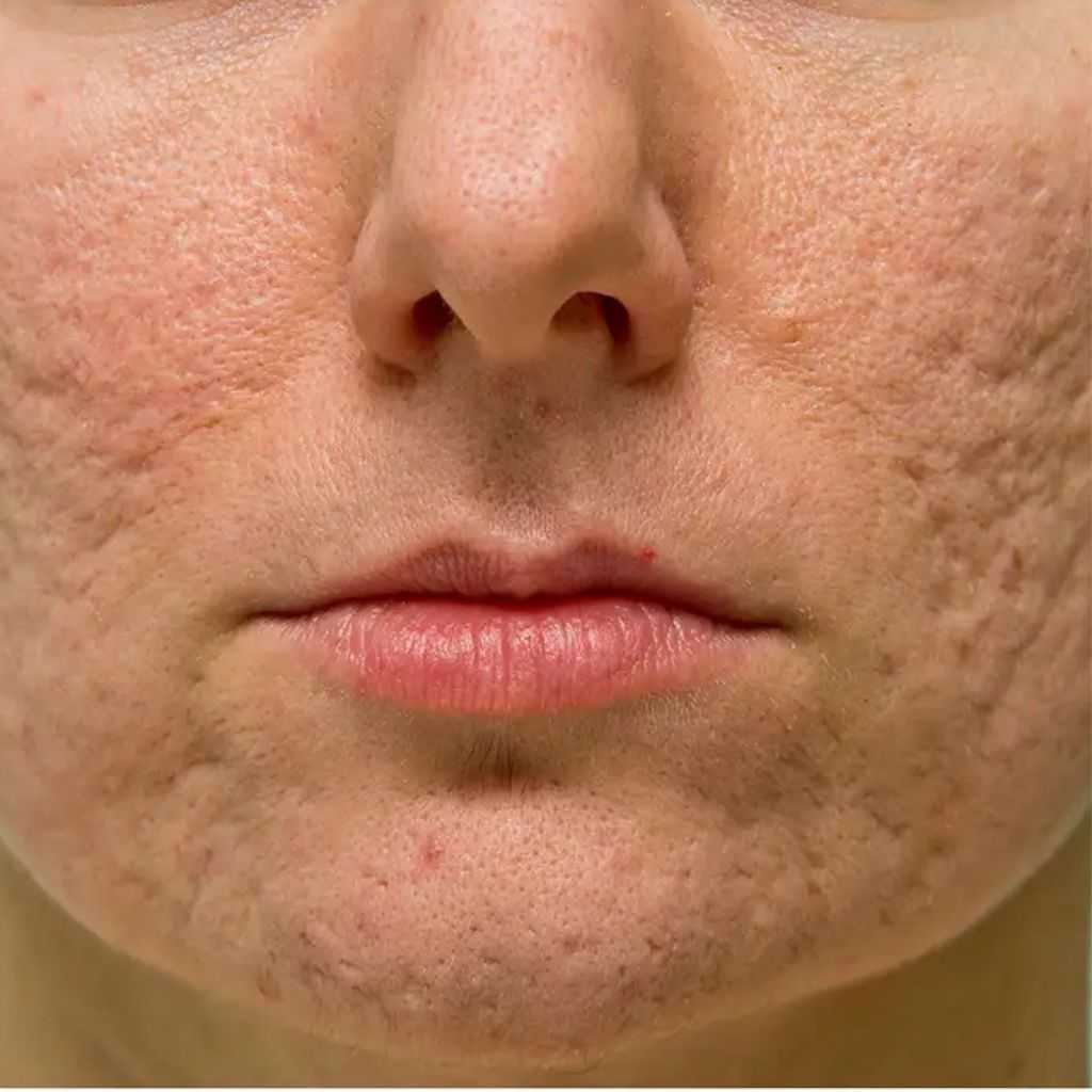 Can Acne Scars Be 100% Removed