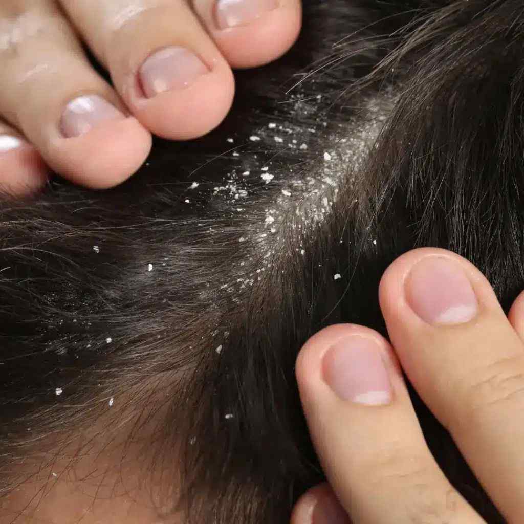 How to 100% get rid of dandruff