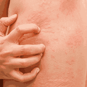 How to remove skin allergy