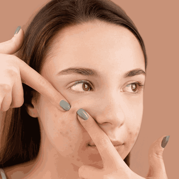 Is it correct to pop a pimple