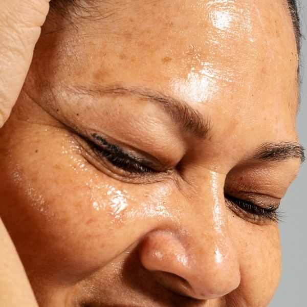 Which Treatment Is Best for Oily Skin?