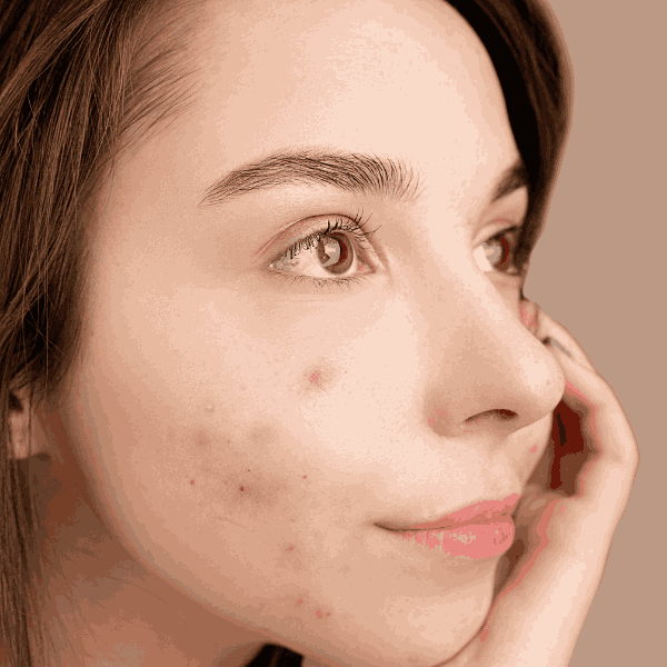 Why Is My Acne Coming Back Again?