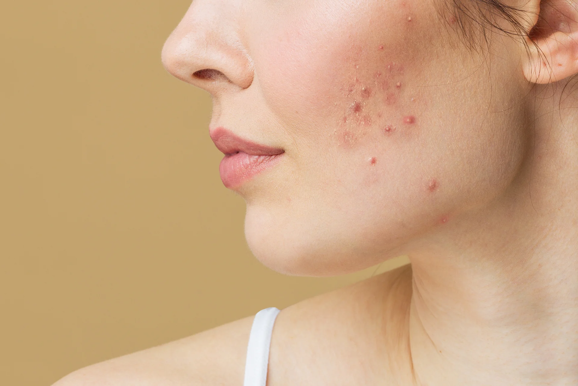 Are Chemical Peels Safe for Acne-Prone Skin?