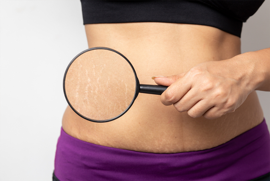 Can MNRF Reduce Stretch Marks Effectively?