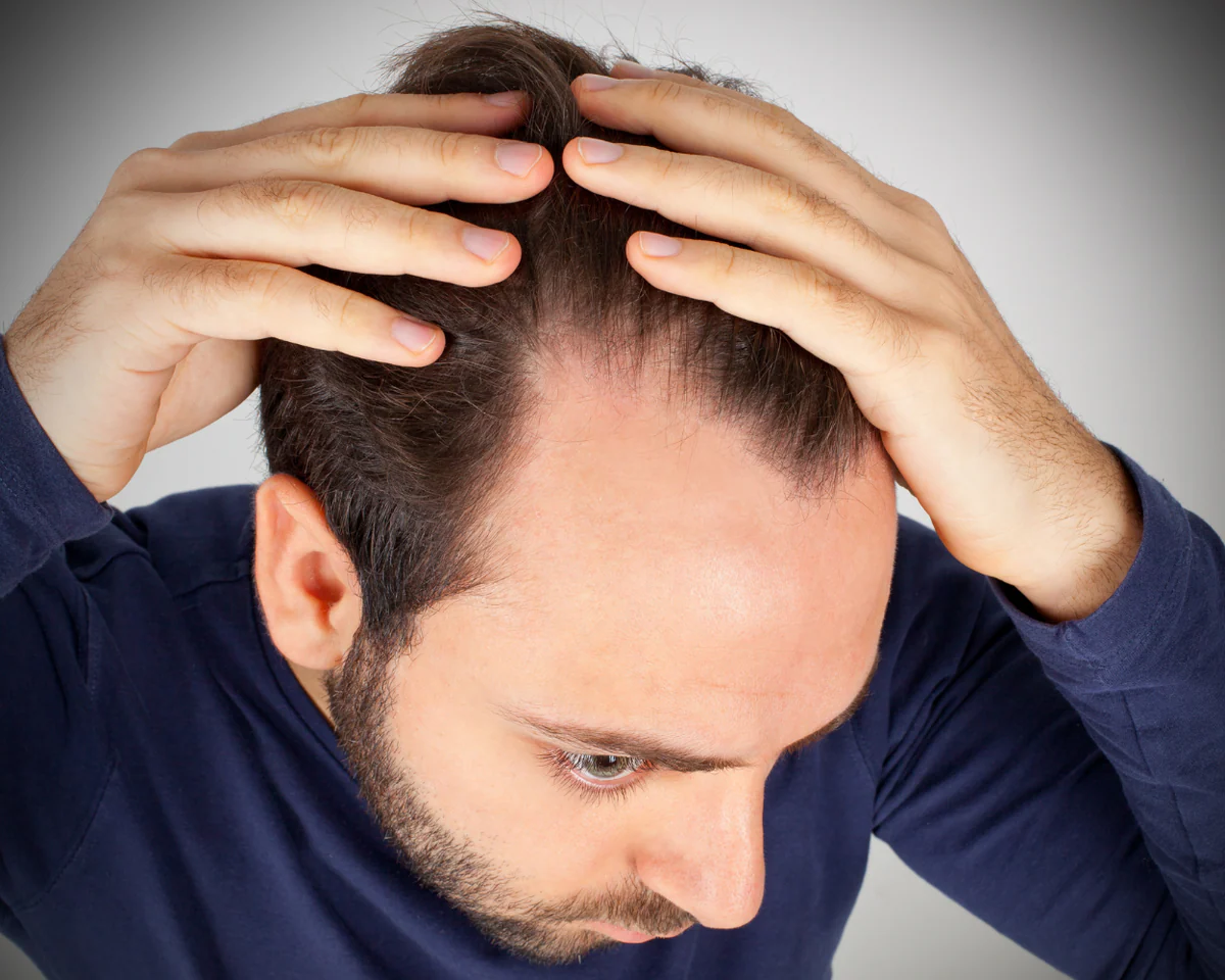 What Is the Cause of Hair Loss in Men? - Dr Hera's Skin and Hair Clinic