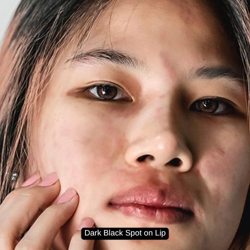 Dark Black Spot on Lip