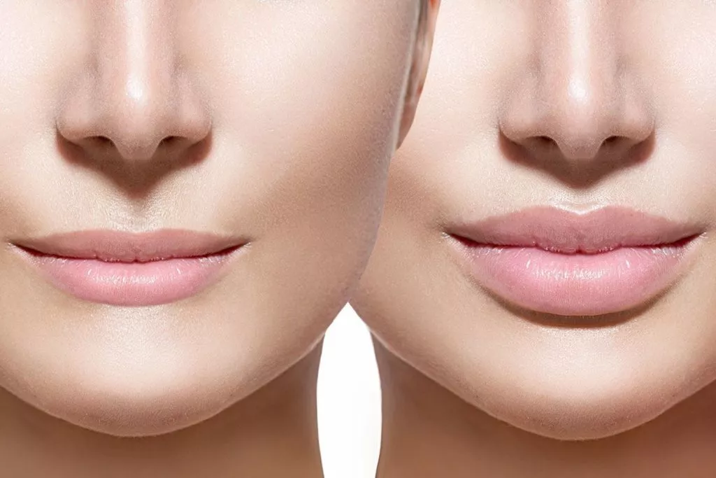 Is Lip Reduction Surgery Right For You?