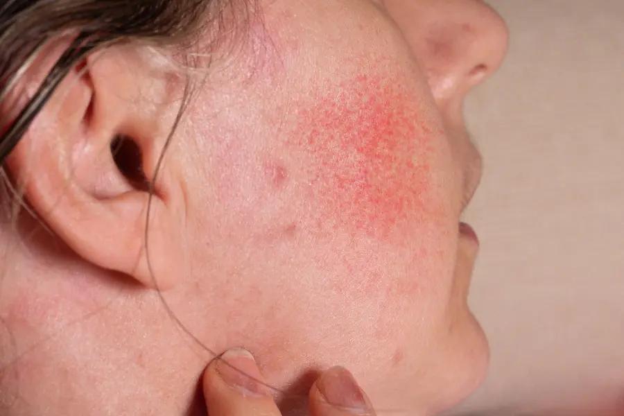 Rosacea on Neck and Chest