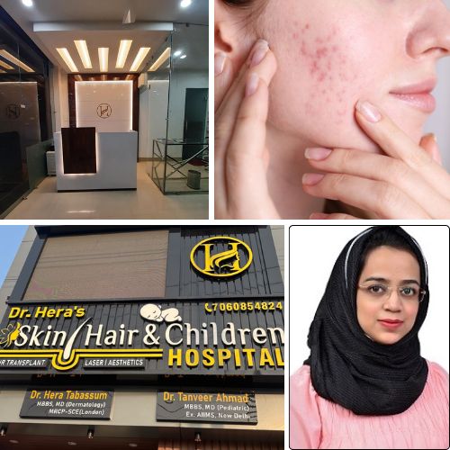 Can Dermapen 4 reduce acne scars?