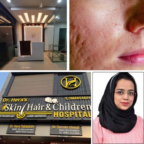 What are the causes of open pores