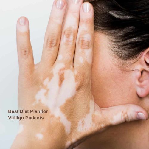 Best Diet Plan for Vitiligo Patients