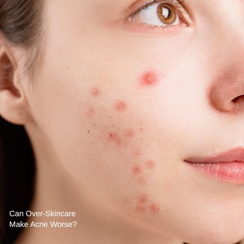 Can Over-Skincare Make Acne Worse?