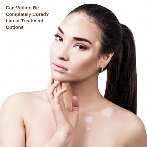 Can Vitiligo Be Completely Cured? Latest Treatment Options