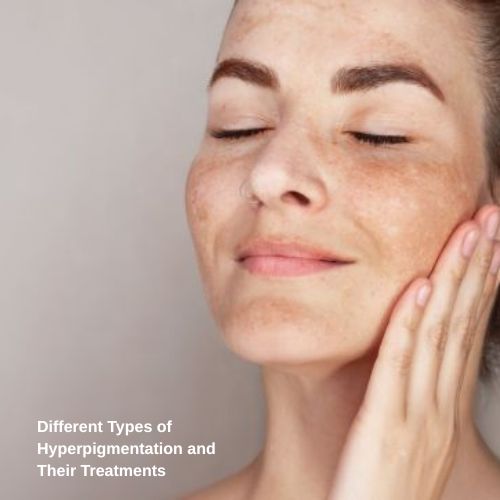 Different Types of Hyperpigmentation & Their Treatments