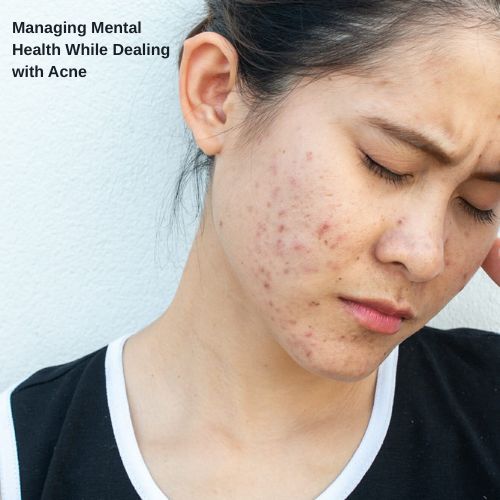 Managing Mental Health While Dealing with Acne