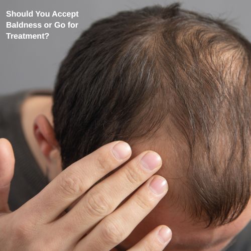 Should You Accept Baldness or Go for Treatment?