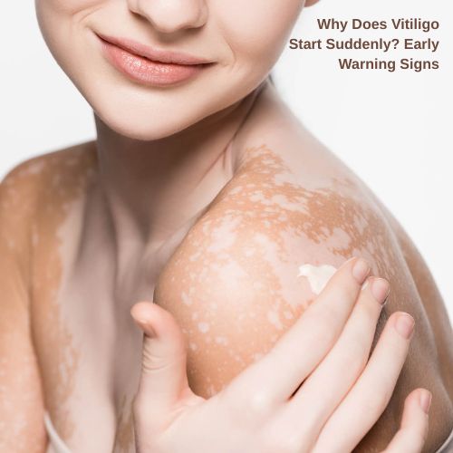 Why Does Vitiligo Start Suddenly? Early Warning Signs
