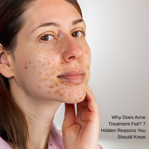 acne treatment not working