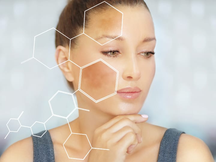Sun Exposure Can Cause Dark Spots