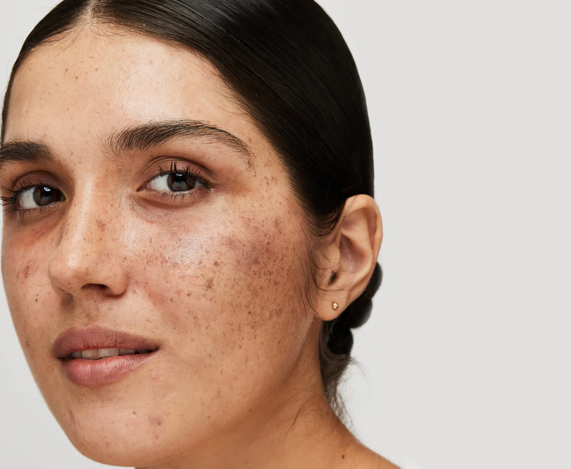 melasma pigmentation on cheeks