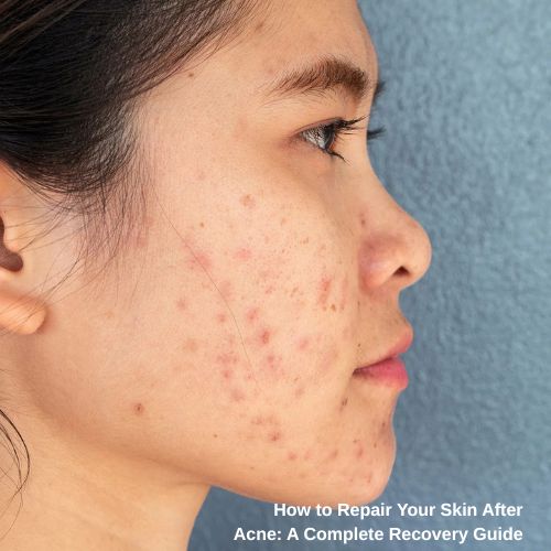 repair skin after acne