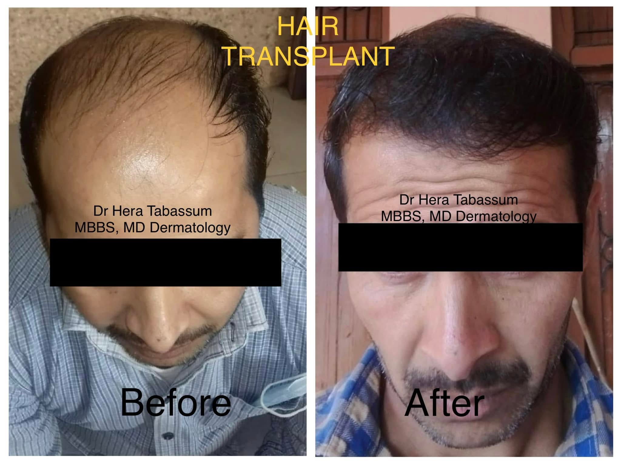 hair-transplant-procedure-before-after-roorkee