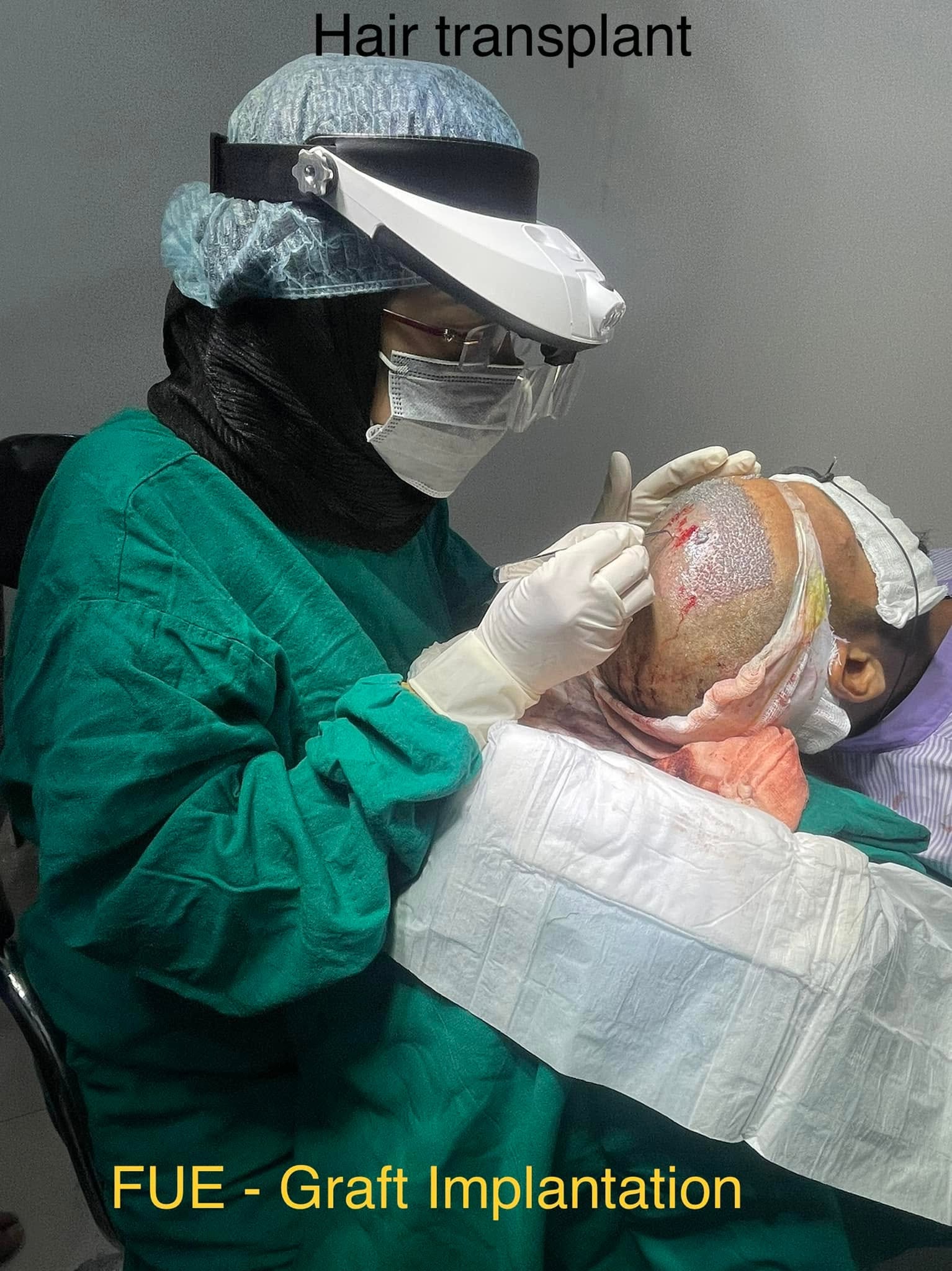 FUE hair transplant graft implantation performed by Dr Hera Tabassum in Roorkee