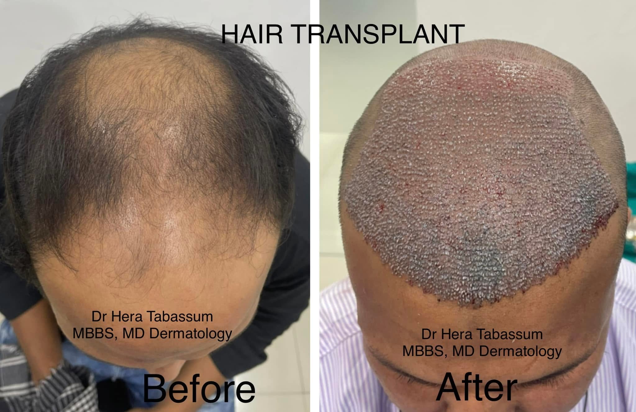 Before and immediate after hair transplant procedure by Dr Hera Tabassum