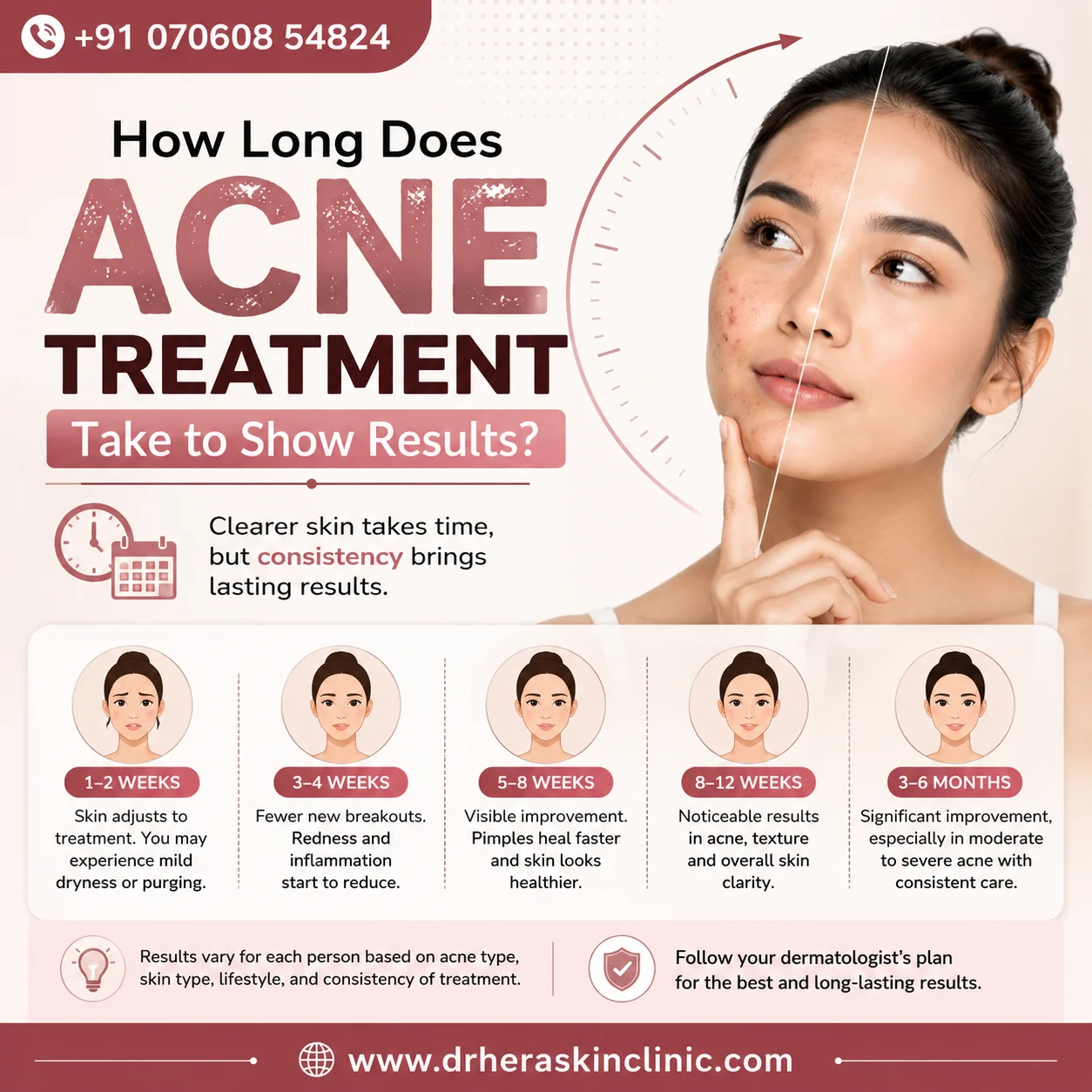 How Long Does Acne Treatment Take to Show Results? Timeline showing acne treatment progress from 1–2 weeks to 3–6 months for clearer skin.
